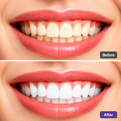 Solu Teeth Whitening Strips